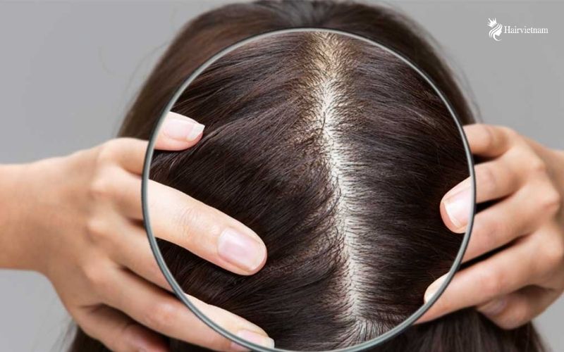 Causes of Dry Scalp